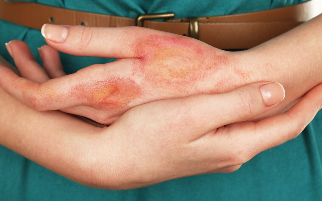 Burn Injuries: A Call for Corporate Responsibility