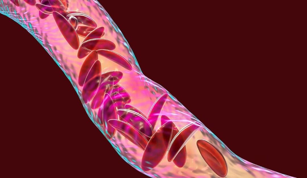 Sickle Cell Disease Awareness and the Oxbryta Lawsuit