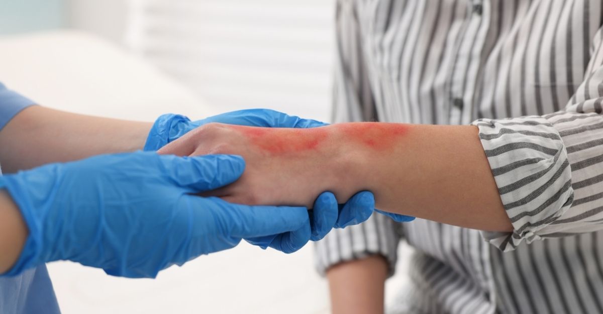 Burn Injury Settlement Timeline – New Orleans Injury Lawyer