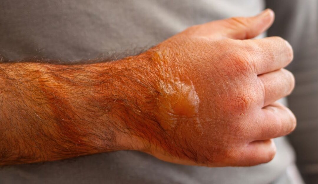 Louisiana Burn Injury Settlements – Your Legal Guide
