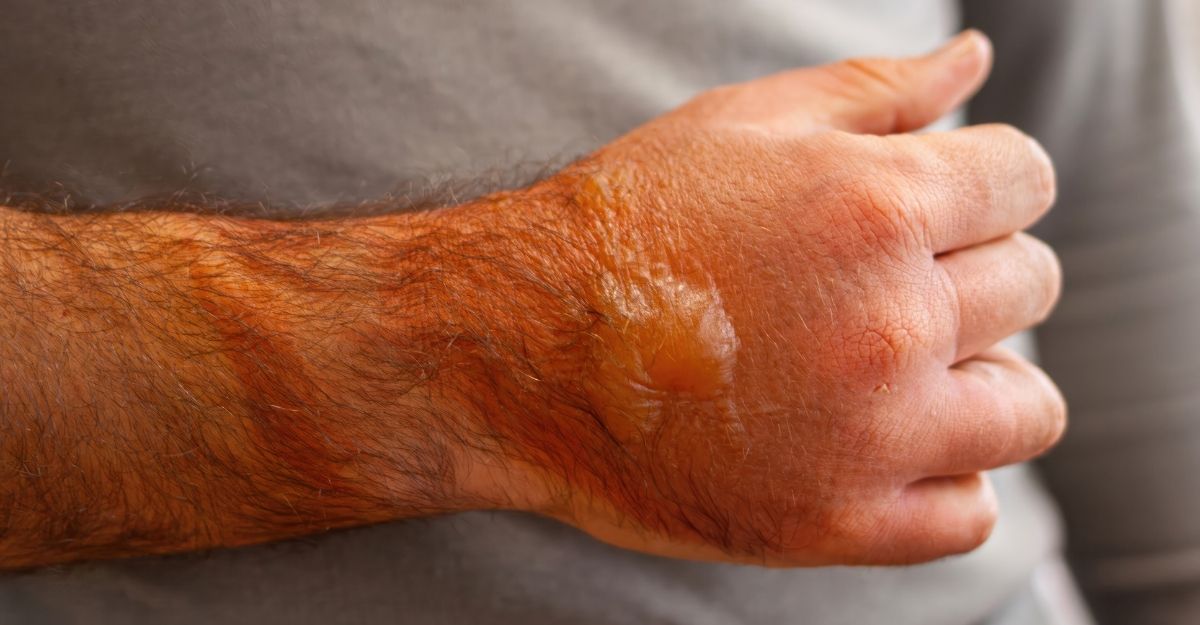 Louisiana Burn Injury Settlements – Your Legal Guide