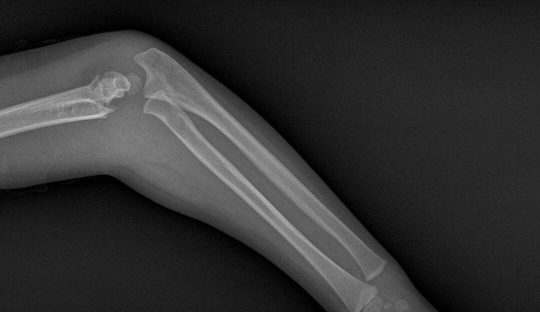 Broken Bones and Fractures from Accidents in Louisiana