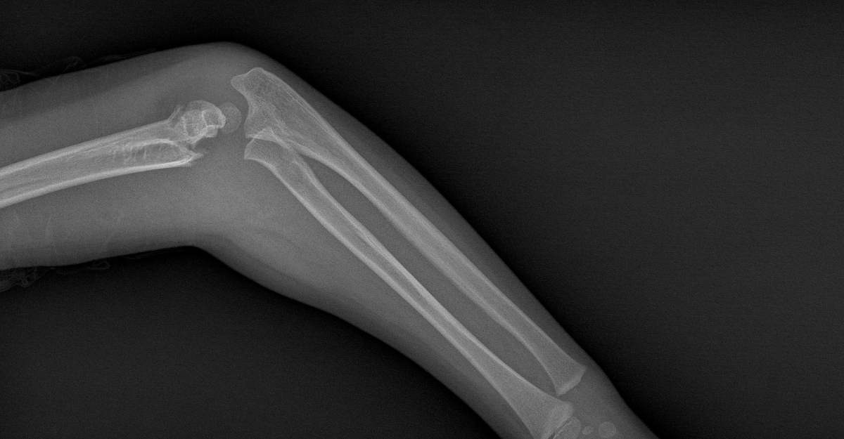 Broken Bones and Fractures from Accidents in Louisiana