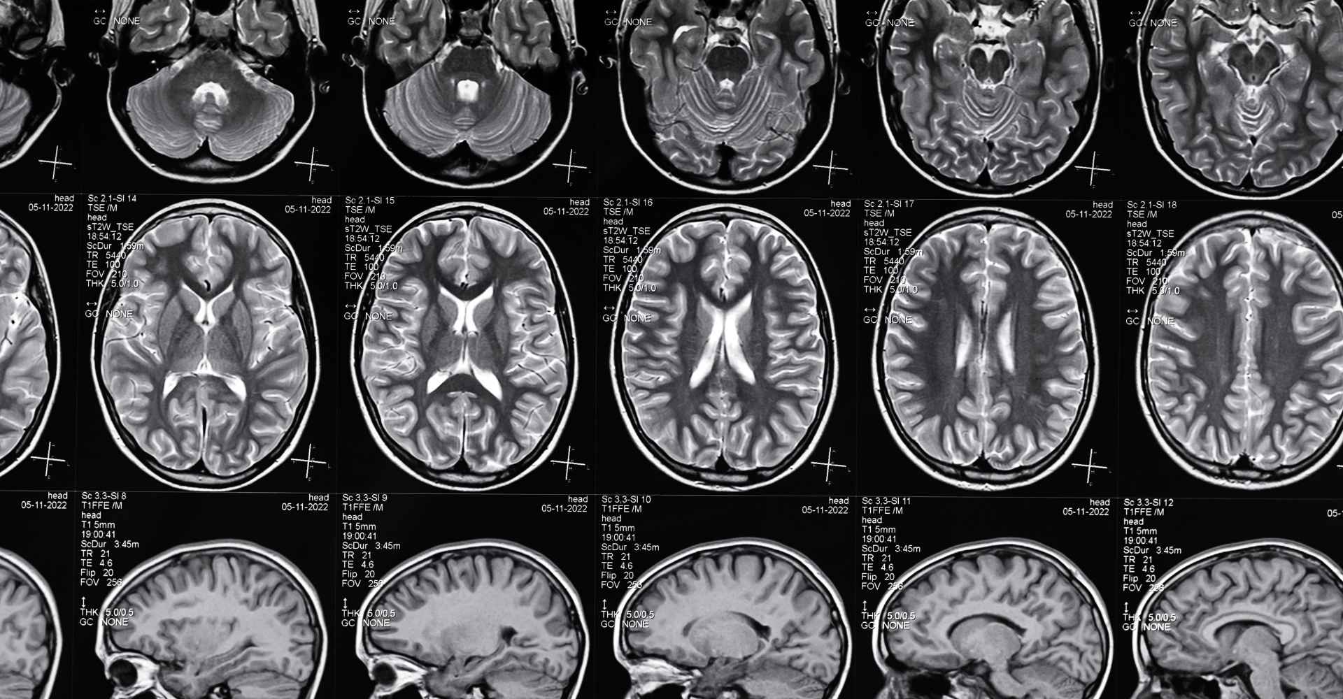 TBI in New Orleans: Reagan Thomas on Traumatic Brain Injuries