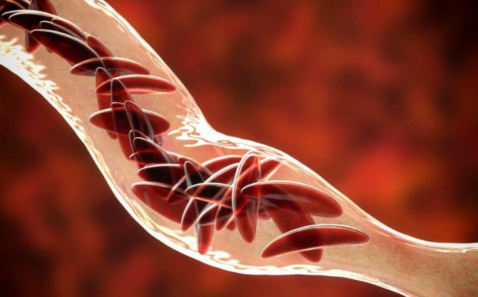 sickle cell disease