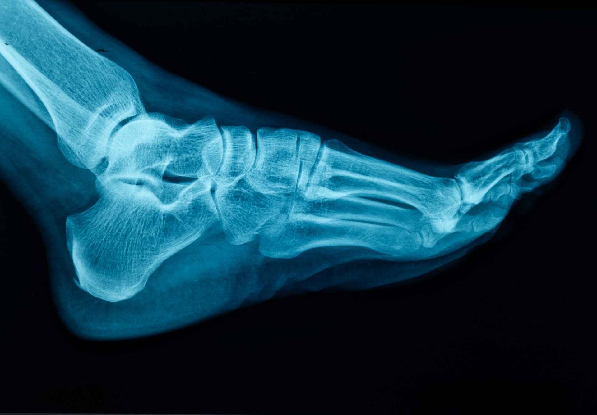 Cartiva Implant Lawsuit